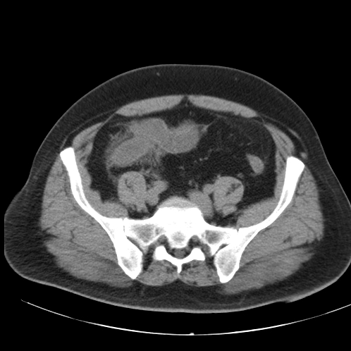 File:Appendicitis and giant appendicolith (Radiopaedia 80251-93588 Axial non-contrast 43).jpg