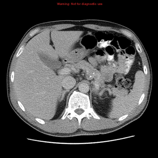 File:Appendicitis and renal cell carcinoma (Radiopaedia 17063-16760 A 14).jpg