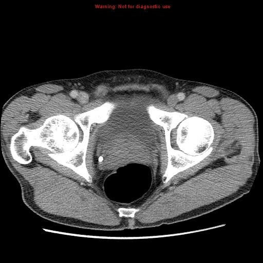 Appendicitis and renal cell carcinoma (Radiopaedia 17063-16760 A 55).jpg