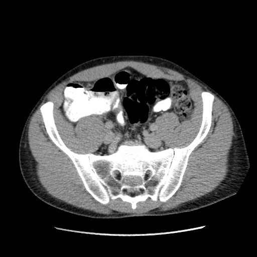 File:Appendicitis complicated by post-operative collection (Radiopaedia 35595-37113 A 57).jpg