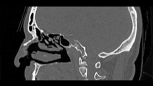 File:Arcuate foramen (Radiopaedia 89833-106944 Sagittal bone window 41).jpg
