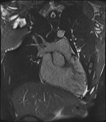 Arrhythmogenic right ventricular cardiomyopathy (Radiopaedia 57972-64966 CINE R2 SSFP 3).jpg