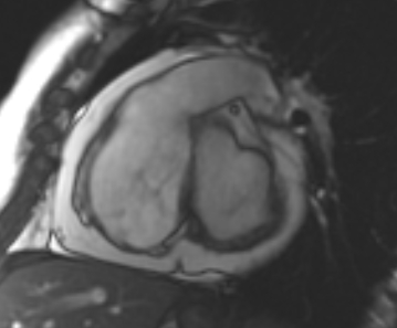 Arrhythmogenic right ventricular cardiomyopathy (Radiopaedia 69431-79307 Short axis cine 182).jpg