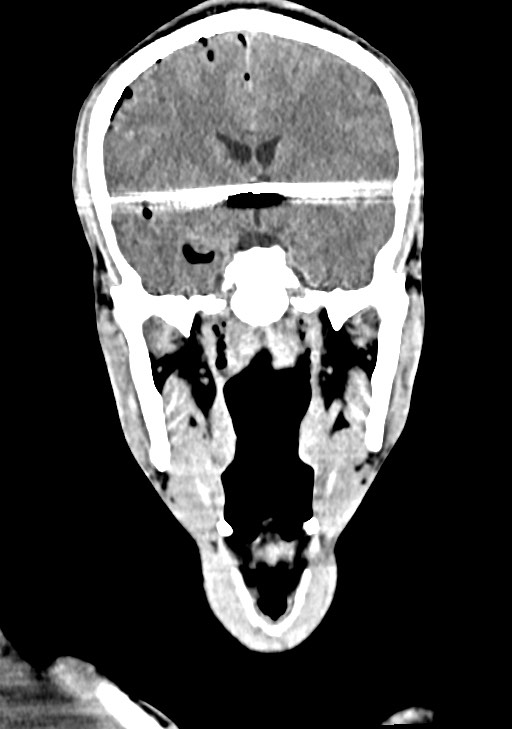 Arrow injury to the brain (Radiopaedia 72101-82607 Coronal non-contrast 38).jpg