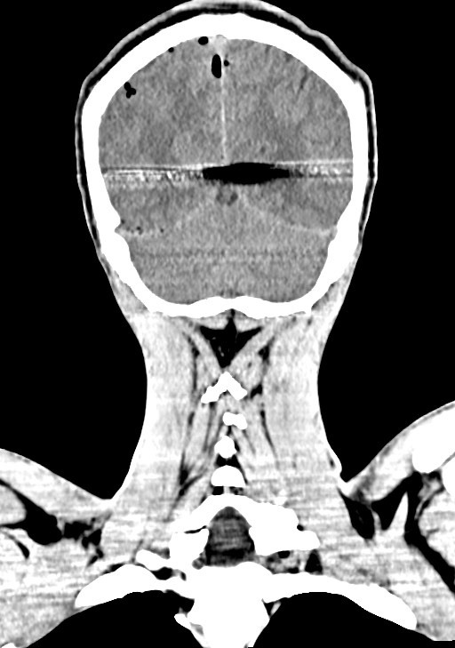 Arrow injury to the brain (Radiopaedia 72101-82607 Coronal non-contrast 58).jpg