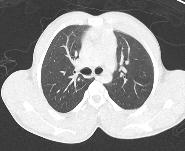 Arrow injury to the chest (Radiopaedia 75223-86321 Axial lung window 23).jpg