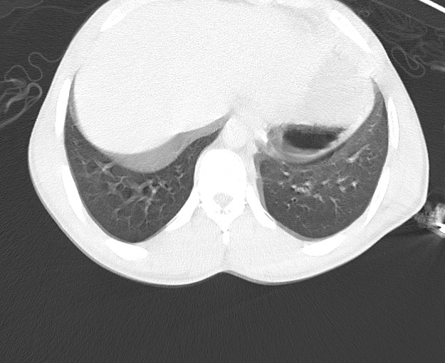 Arrow injury to the chest (Radiopaedia 75223-86321 Axial lung window 82).jpg