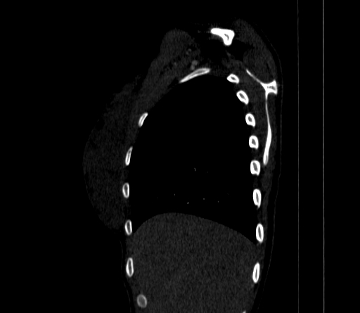 File:Arteria lusoria (Radiopaedia 88528-105192 C 23).jpg