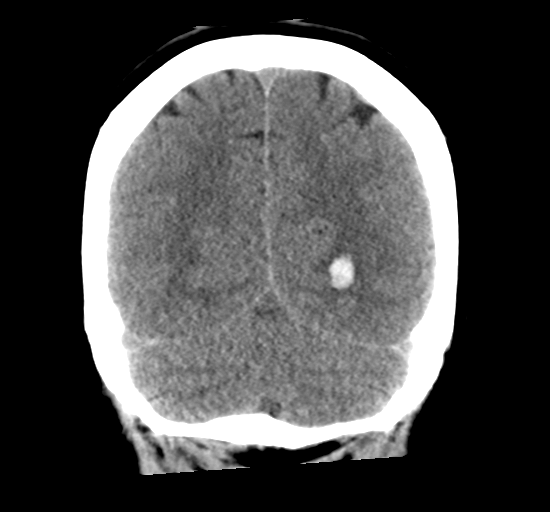 File:Arteriovenous malformation (cerebral) (Radiopaedia 40070-42579 Coronal non-contrast 30).png