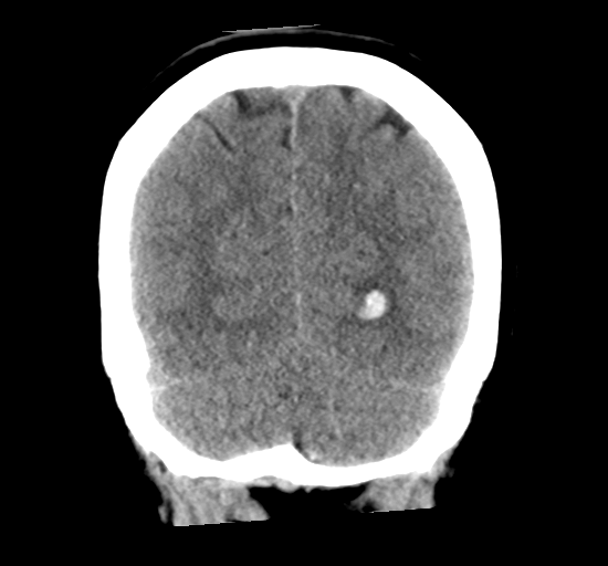 File:Arteriovenous malformation (cerebral) (Radiopaedia 40070-42579 Coronal non-contrast 31).png