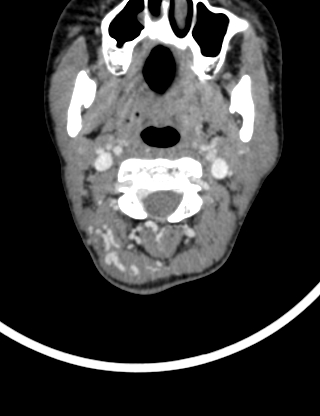 File:Arteriovenous malformation of the neck (Radiopaedia 53935-60062 B 11).jpg