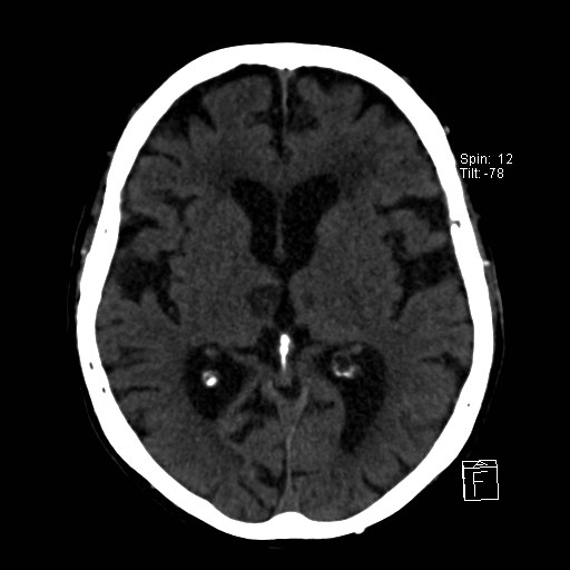 File:Artery of Percheron infarction (Radiopaedia 26307-26439 Axial non-contrast 19).jpg