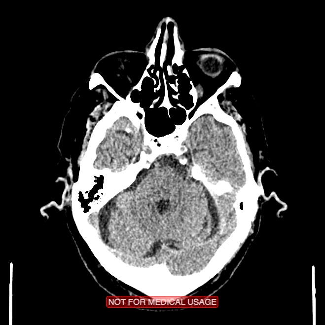 Artery of Percheron infarction (Radiopaedia 28679-28967 Axial non-contrast 33).jpg