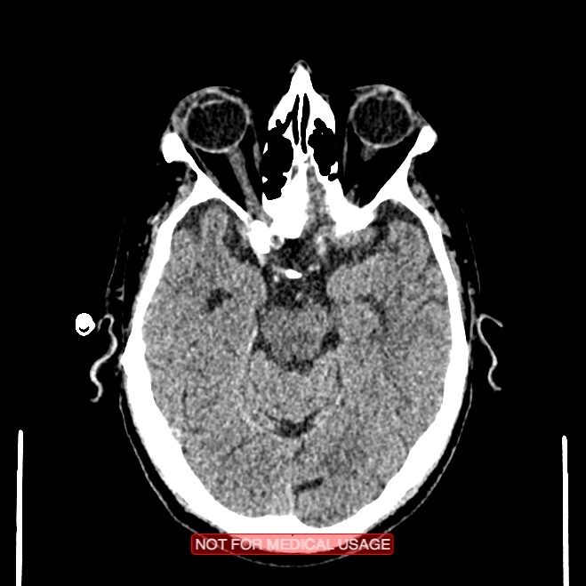 Artery of Percheron infarction (Radiopaedia 28679-28967 Axial non-contrast 44).jpg