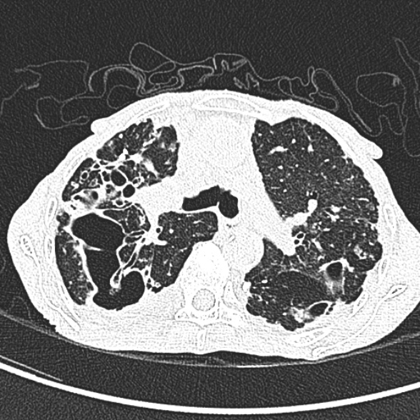 Aspergilloma- with Monod sign (Radiopaedia 44737-48532 Axial lung window 99).jpg