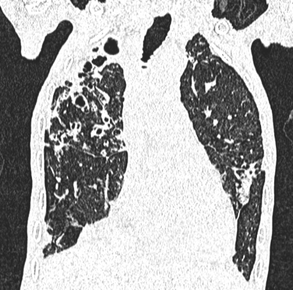 Aspergilloma- with Monod sign (Radiopaedia 44737-48532 Coronal lung window 206).jpg