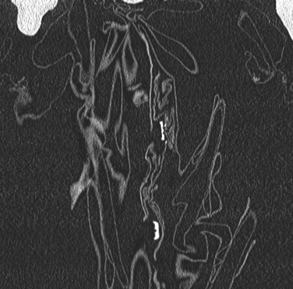 Aspergilloma- with Monod sign (Radiopaedia 44737-48532 Coronal lung window 81).jpg
