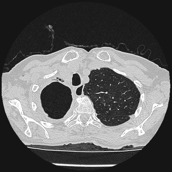 Aspergilloma (Radiopaedia 24458-24763 Axial lung window 11).jpg