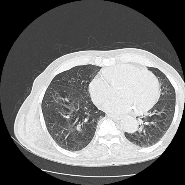Aspergilloma (Radiopaedia 44592-48327 Axial lung window 61).jpg