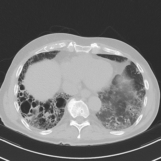 File:Aspergilloma on background pulmonary fibrosis (Radiopaedia 60942-68757 A 42).jpg