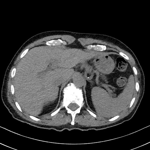 Aspergilloma on background pulmonary fibrosis (Radiopaedia 60942-68757 Axial non-contrast 55).jpg
