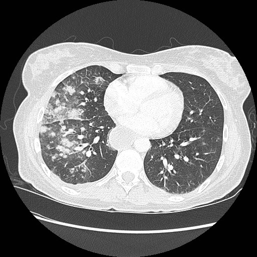 Aspiration pneumonia secondary to laparoscopic banding (Radiopaedia 18345-18183 lung window 70).jpg