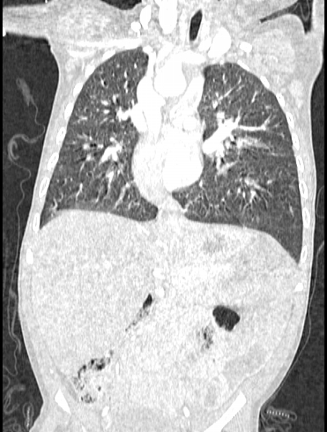 Asplenia syndrome (Radiopaedia 73083-83792 Coronal lung window 71).jpg