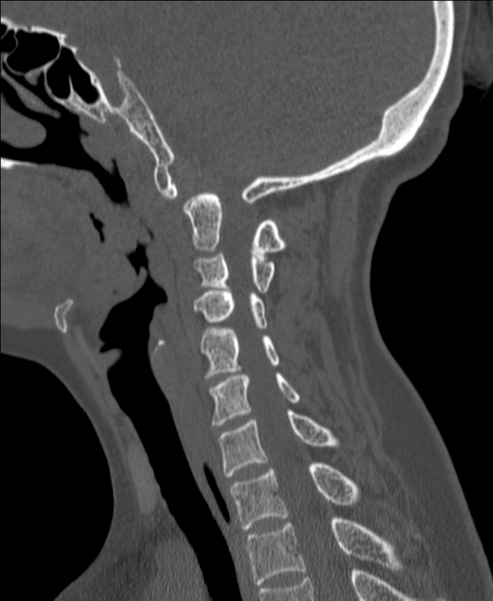 Atlanto-occipital assimilation with basilar invagination (Radiopaedia 70122-80188 Sagittal bone window 84).jpg