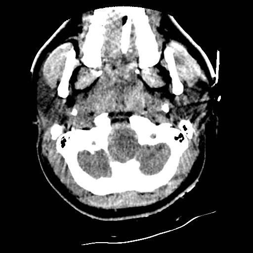 Atlanto-occipital dislocation (Radiopaedia 44648-48412 Axial non-contrast 7).jpg