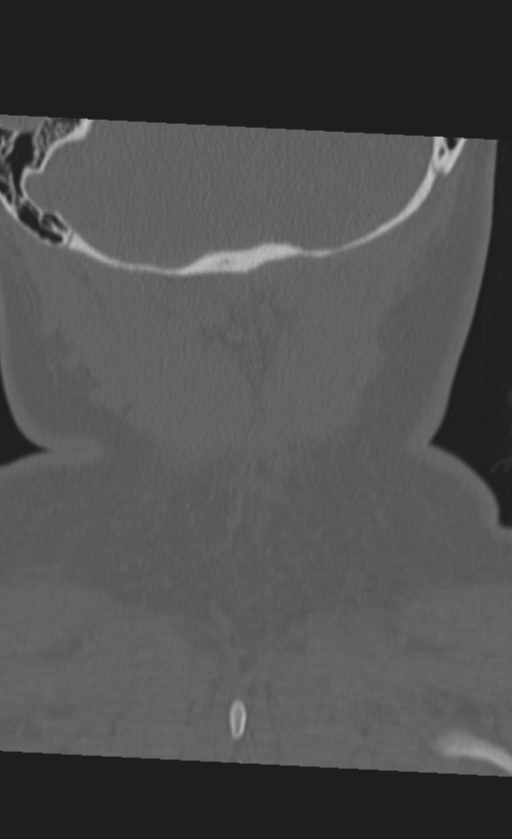 Atlanto-occipital dissociation (Radiopaedia 33848-35013 Coronal bone window 53).png