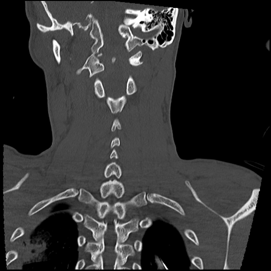Atlanto-occipital dissociation (Traynelis type 1), C2 teardrop fracture, C6-7 facet joint dislocation (Radiopaedia 87655-104061 Coronal bone window 48).jpg