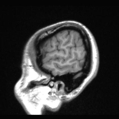 Atretic encephalocoele with inferior vermis hypoplasia (Radiopaedia 30443-31108 Sagittal T1 121).jpg