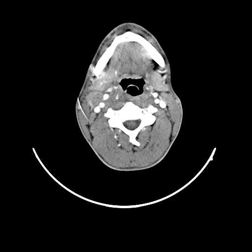 File:Atypical 2nd branchial cleft cyst (type IV) - infected (Radiopaedia 20986-20924 A 13).jpg