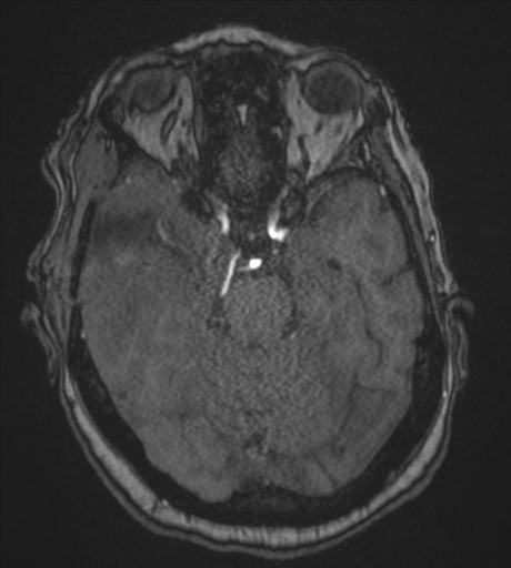 Atypical meningioma (WHO Grade II) (Radiopaedia 54742-60981 Axial MRA 35).png