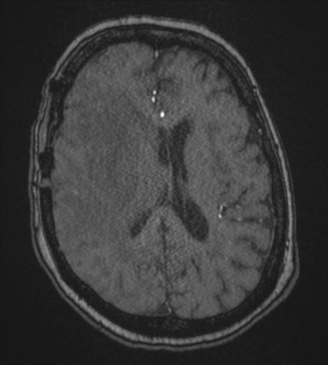 Atypical meningioma (WHO Grade II) (Radiopaedia 54742-60981 Axial MRA 60).png