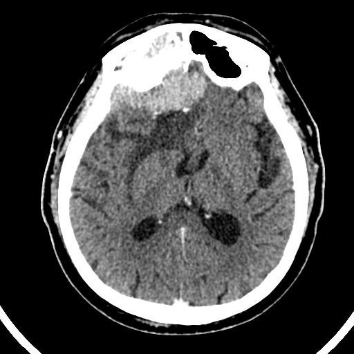 Atypical meningioma (WHO grade II) with brain invasion (Radiopaedia 57767-64728 Axial C+ 28).png