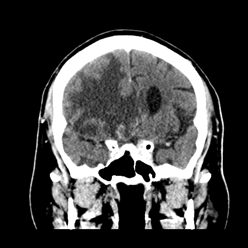 Atypical meningioma (WHO grade II) with brain invasion (Radiopaedia 57767-64728 Coronal C+ 24).png