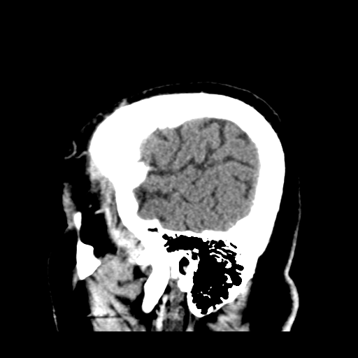 Atypical meningioma (WHO grade II) with brain invasion (Radiopaedia 57767-64728 Sagittal C+ 46).png