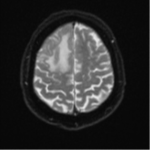 Atypical meningioma (WHO grade II) with brain invasion (Radiopaedia 57767-64729 Axial DWI 24).png