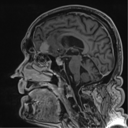 Atypical meningioma (WHO grade II) with brain invasion (Radiopaedia 57767-64729 Sagittal T1 C+ 34).png