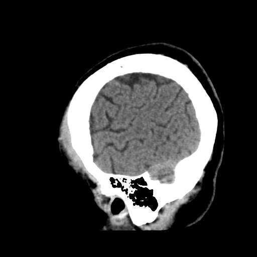 Atypical meningioma (WHO grade II) with osseous invasion (Radiopaedia 53654-59715 C 47).png