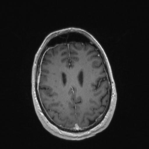 Atypical meningioma (grade II) - en plaque (Radiopaedia 29633-30147 Axial T1 C+ 133).jpg