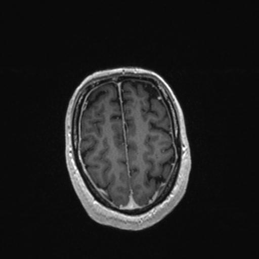 Atypical meningioma (grade II) - en plaque (Radiopaedia 29633-30147 Axial T1 C+ 150).jpg