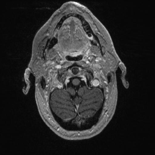 Atypical meningioma (grade II) - en plaque (Radiopaedia 29633-30147 Axial T1 C+ 24).jpg