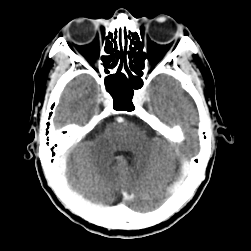 File:Atypical meningioma with skull invasion (Radiopaedia 34357-35649 Axial C+ delayed 17).png
