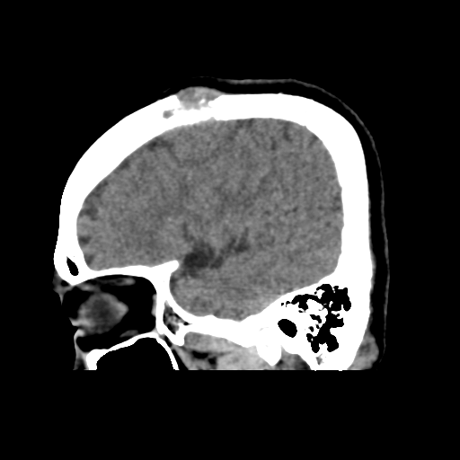 File:Atypical meningioma with skull invasion (Radiopaedia 34357-35649 E 12).png