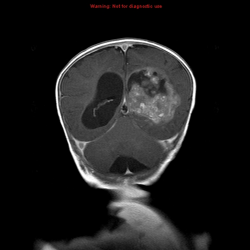 File:Atypical teratoid rhabdoid tumor (Radiopaedia 10712-11183 Coronal T1 C+ 6).jpg