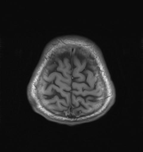 File:Autoimmune limbic encephalitis (Radiopaedia 30363-31005 Axial T1 29).jpg