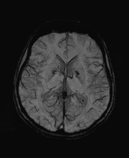 Autoimmune limbic encephalitis (Radiopaedia 30363-31005 SWI - mIP 38).jpg