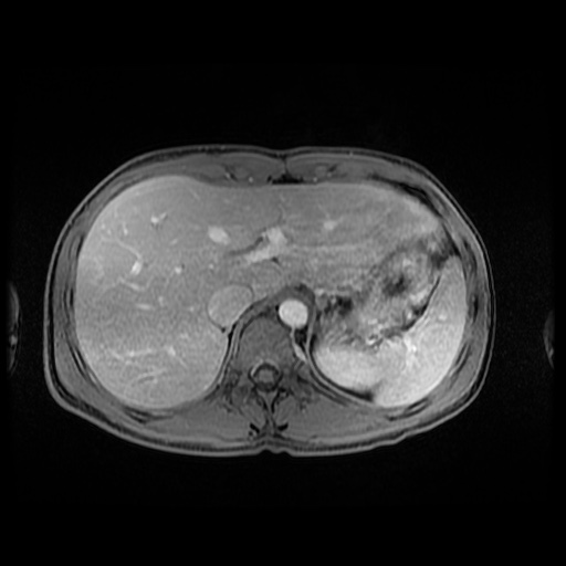 Autoimmune pancreatitis (Radiopaedia 69751-79729 M 34).jpg